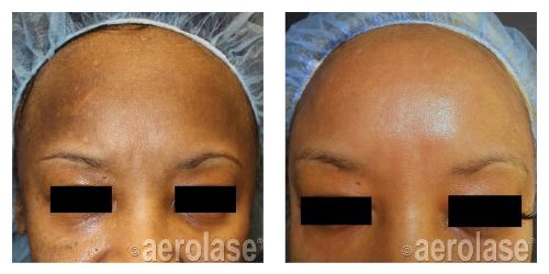 After 1 Treatment combined with Glycolic Peel 